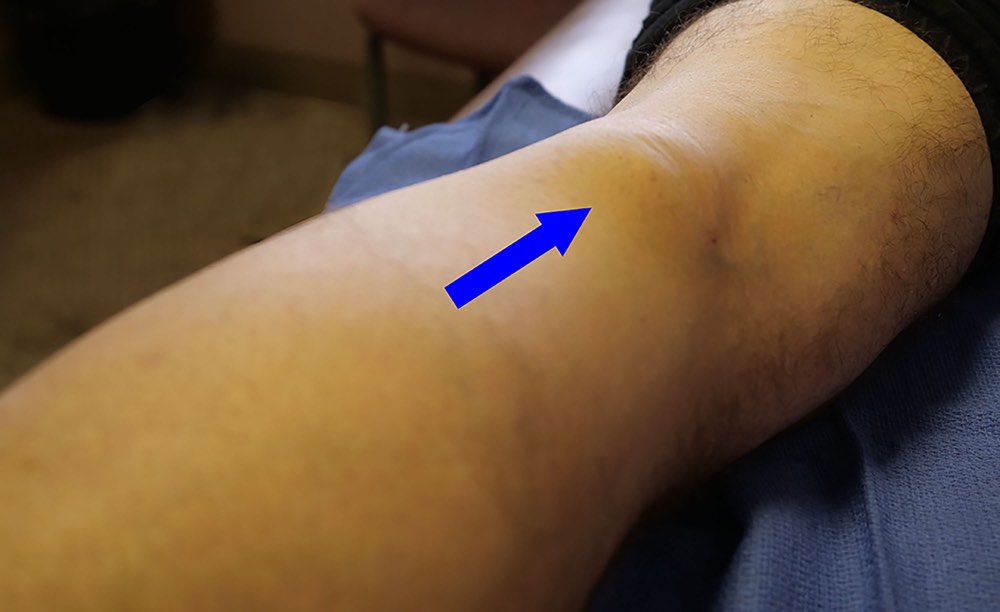 popliteal cyst