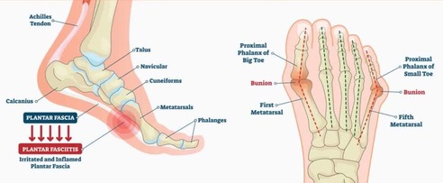 Foot pain – Causes & Treatment