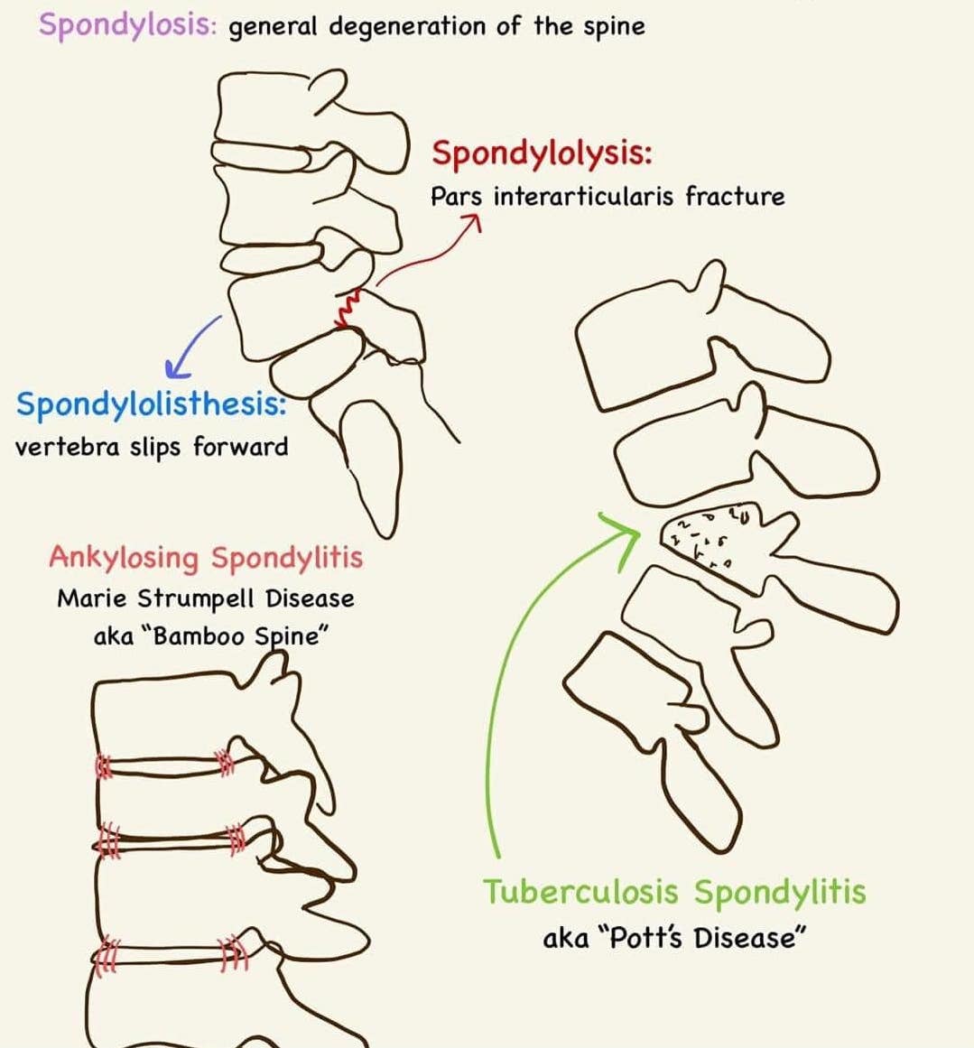 Spondylolysis, Spondylolisthesis, Spondylitis & Spondylosis