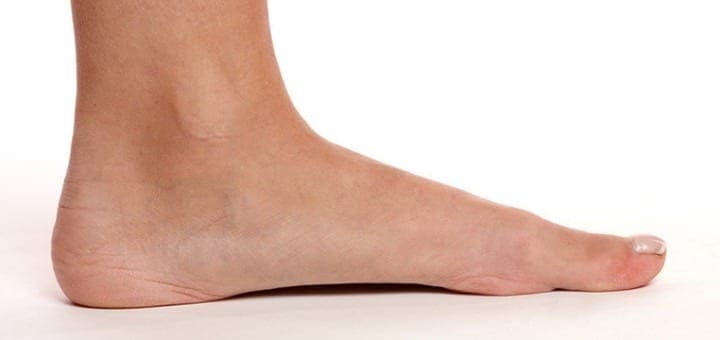 Flat feet – Symptoms and causes