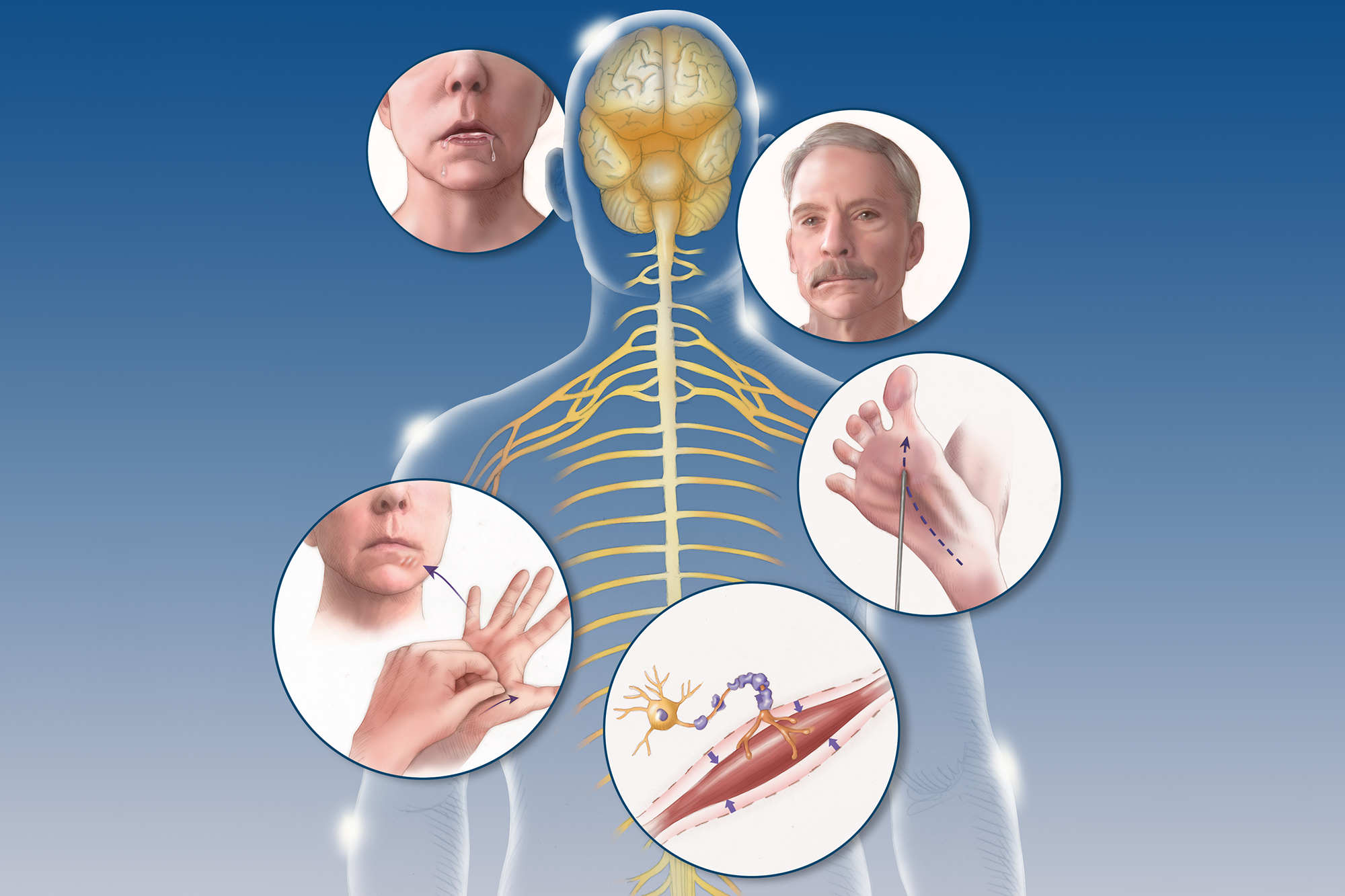 Amyotrophic lateral sclerosis (ALS)