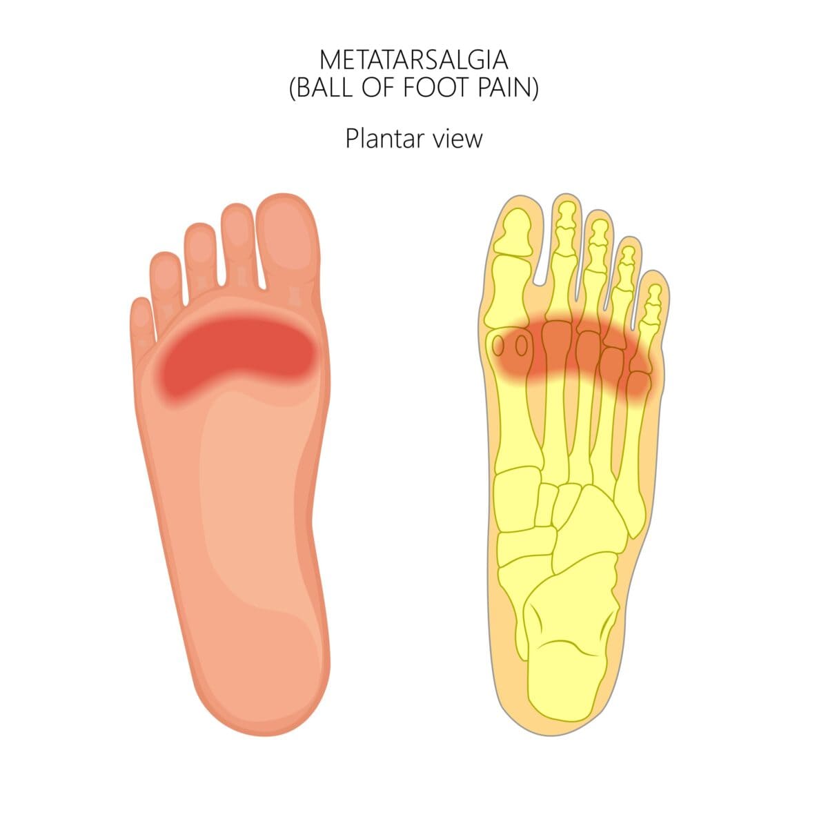 Metatarsalgia – Symptoms & Treatment