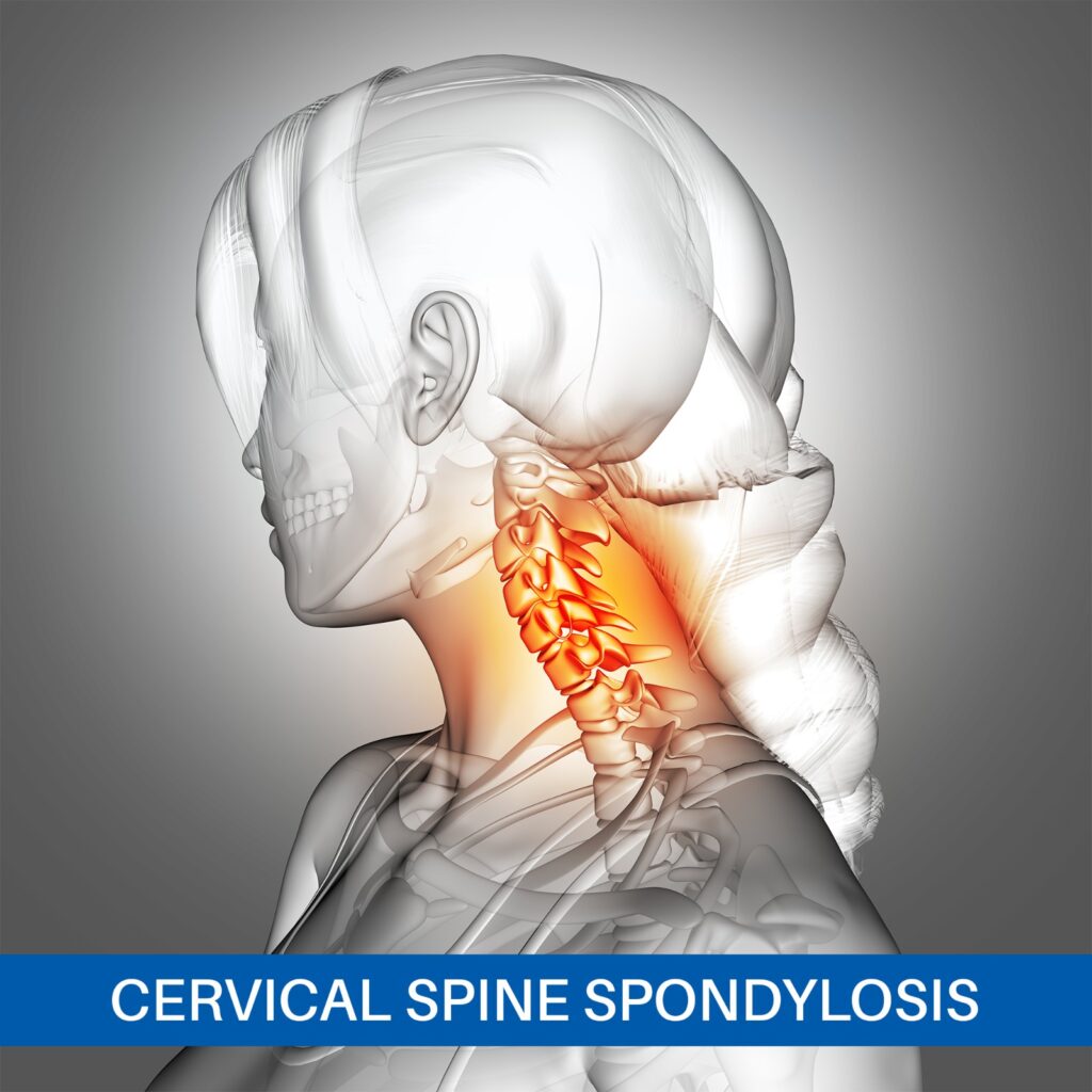 Cervical spondylosis and neck pain