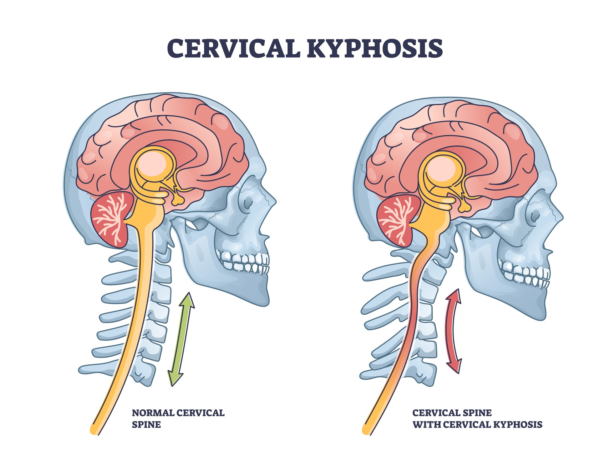 What is military neck?