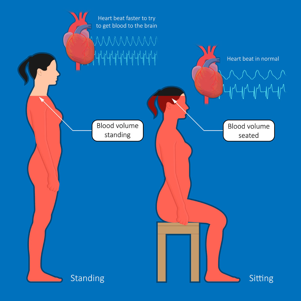 Postural Orthostatic Tachycardia Syndrome(POTS)