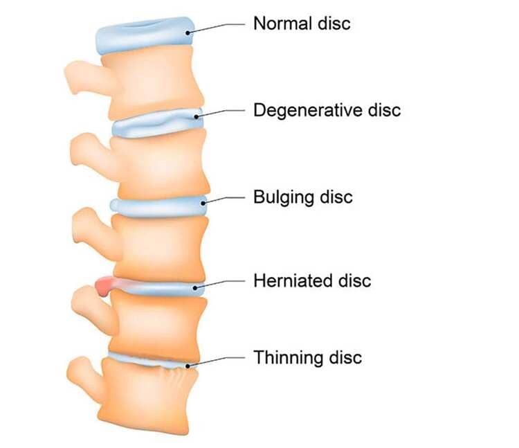 Degenerative Disc Disease