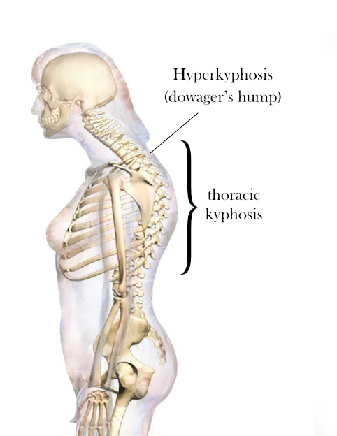 What is a Dowager’s hump (Kyphosis)?