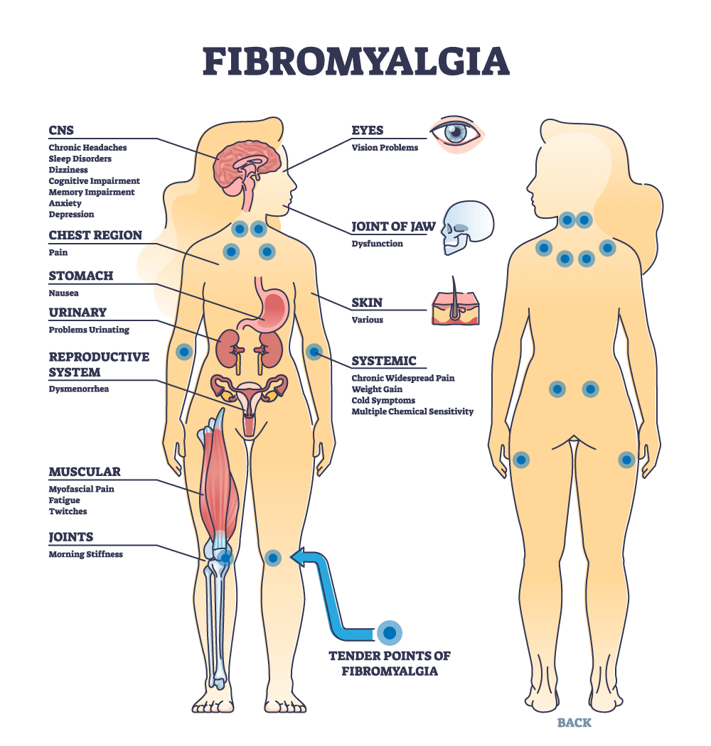 Fibromyalgia – Symptoms & causes