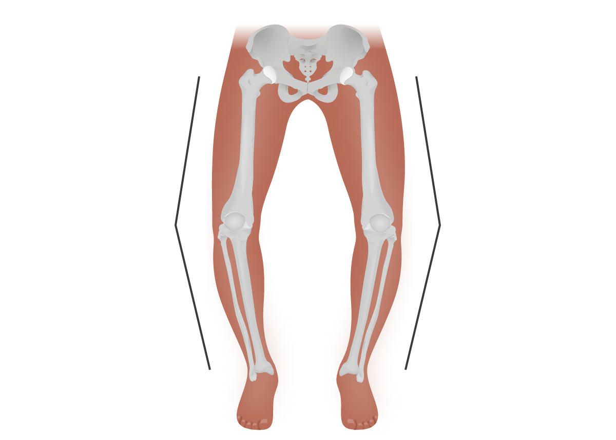 Bow Legs – What’s it, Causes & Treatment