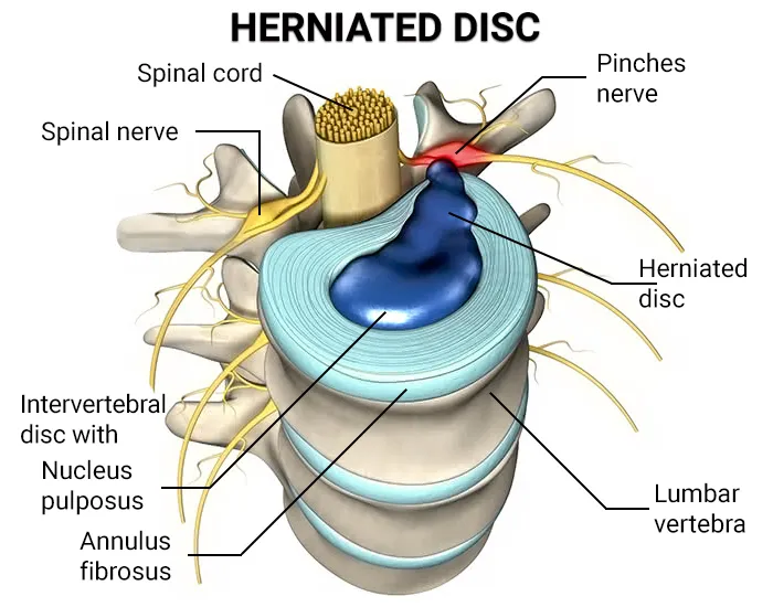 Herniated Disk- Causes & Treatment