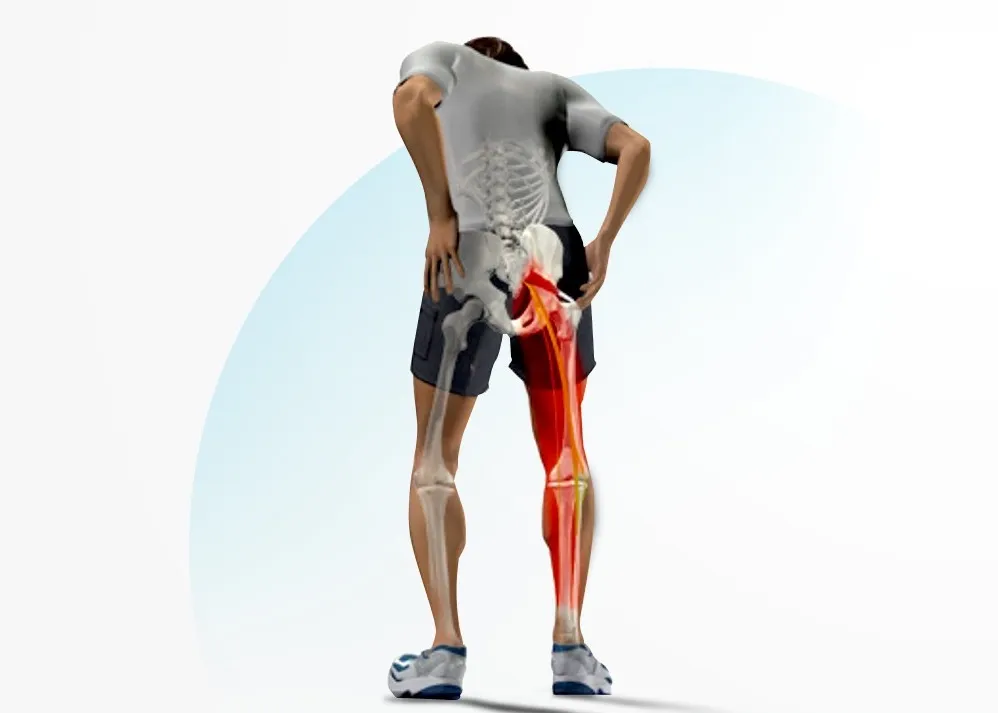 Piriformis Syndrome: Causes & Treatments