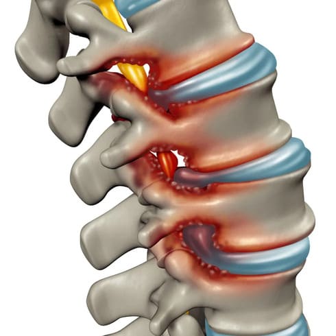 Spinal stenosis – Symptoms and Treatment