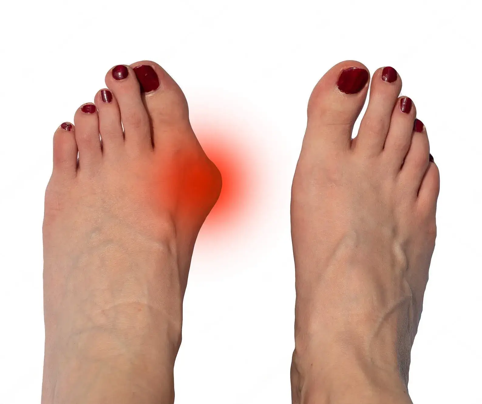 Hallux Valgus (Bunions)