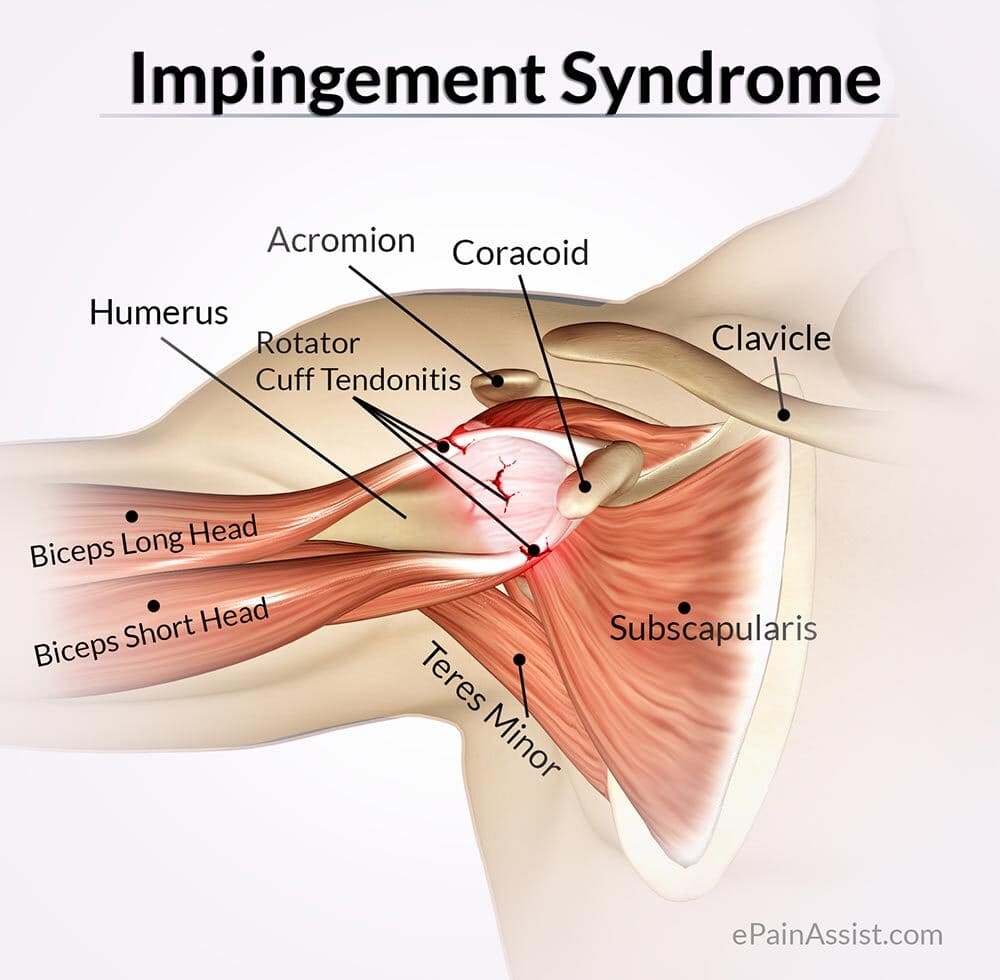   Shoulder Impingement (Rotator Cuff Tendinitis)