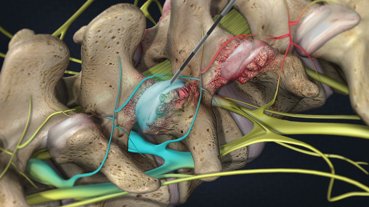 Facet Joint Syndrome / Arthritis