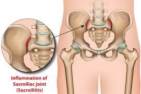 Sacroiliac Joint Dysfunction:Causes, Symptoms