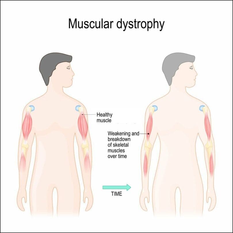 Muscular Dystrophy: Causes andTreatments