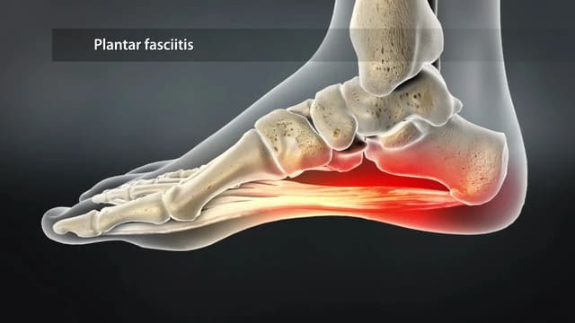 Plantar Fasciitis – Causes & Treatment