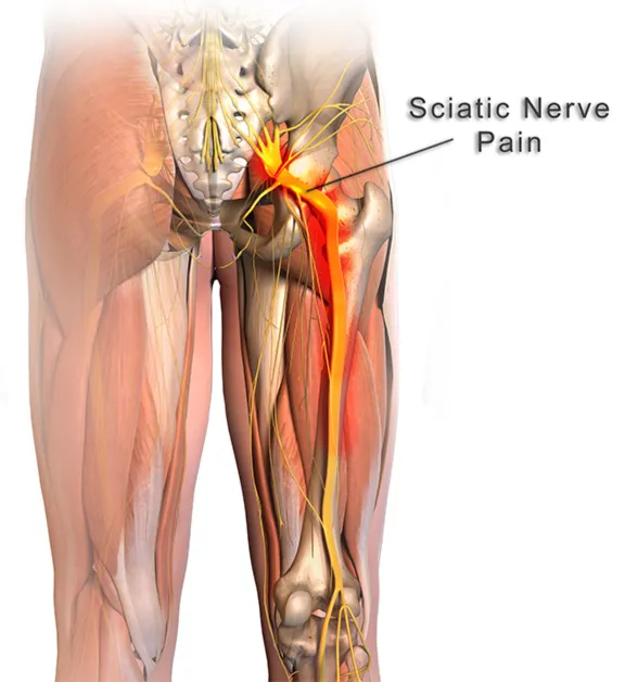 Sciatica: Causes, Symptoms and Treatment