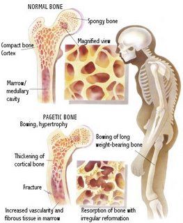 Paget’s disease of bone 