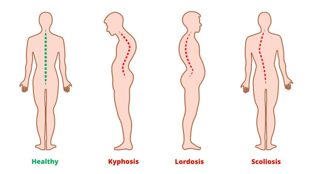 Lordosis vs. Scoliosis and Kyphosis