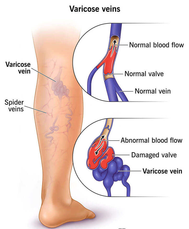 Varicose veins