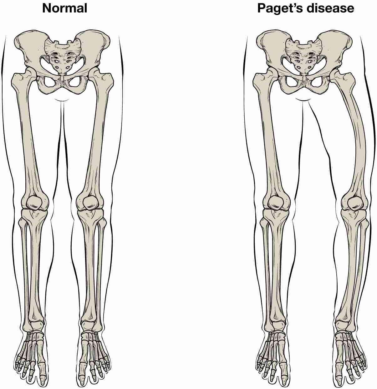 Paget’s disease