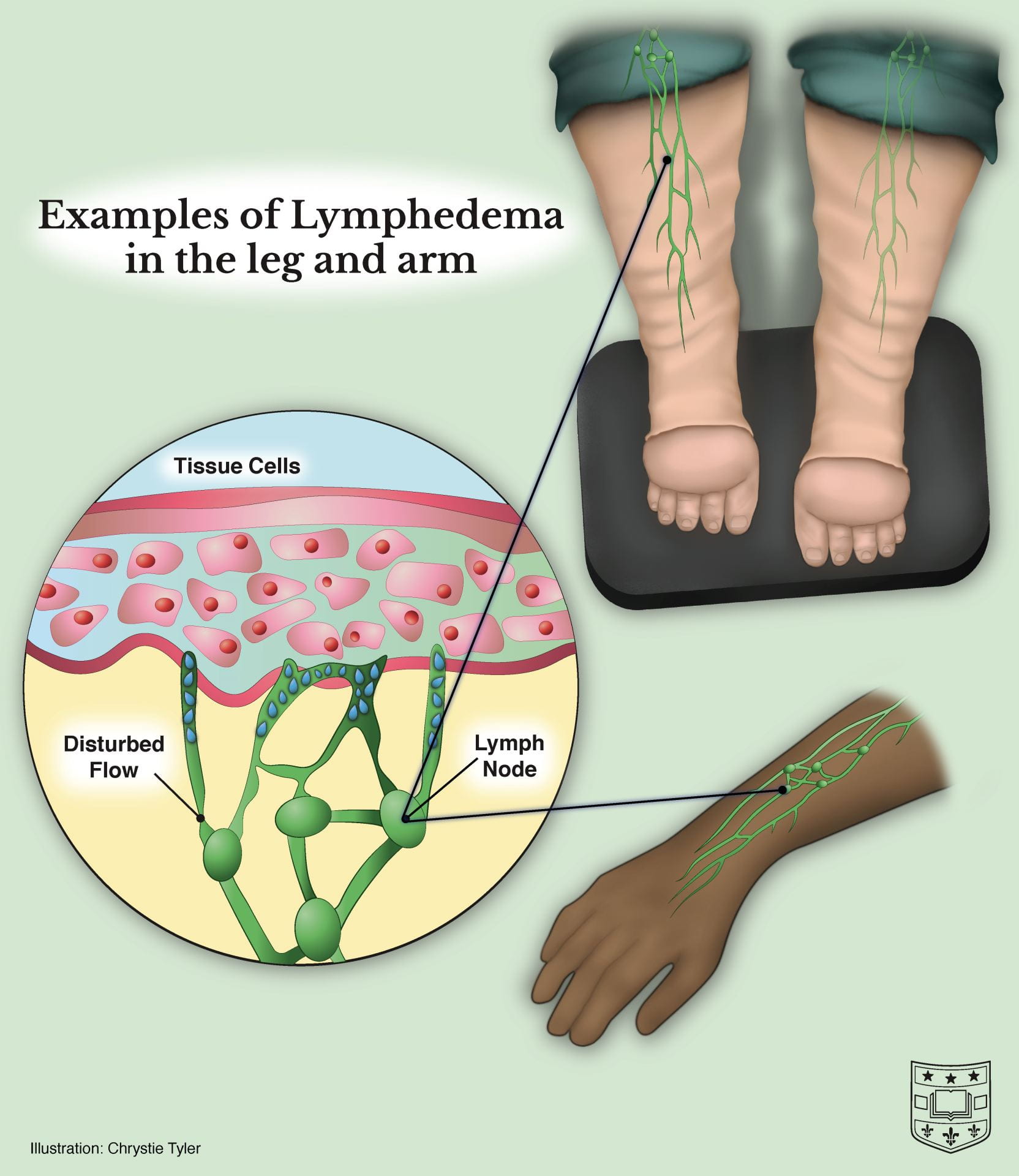 lymphedema