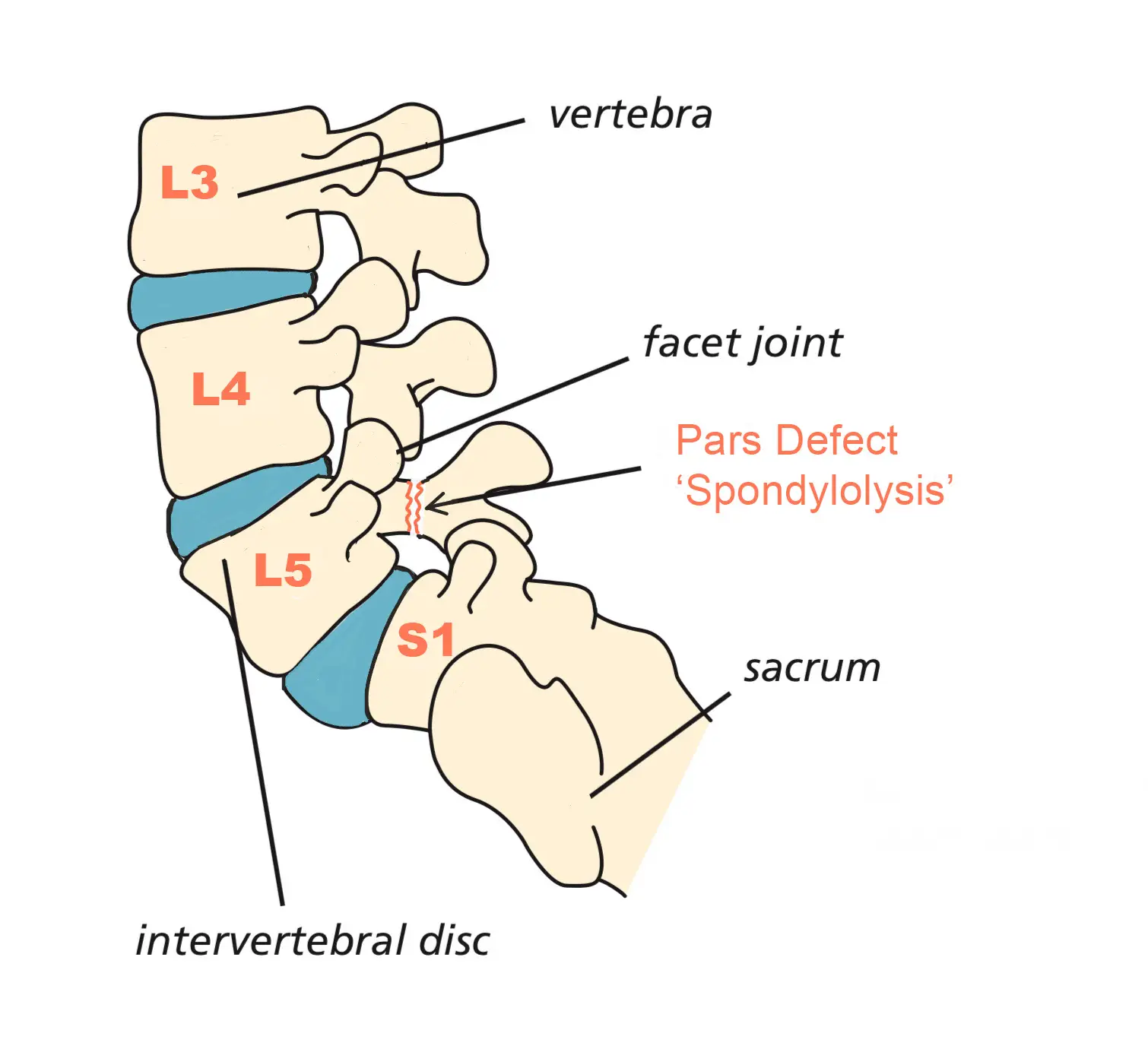 Spondylolysis (Pars Interarticularis Defect)