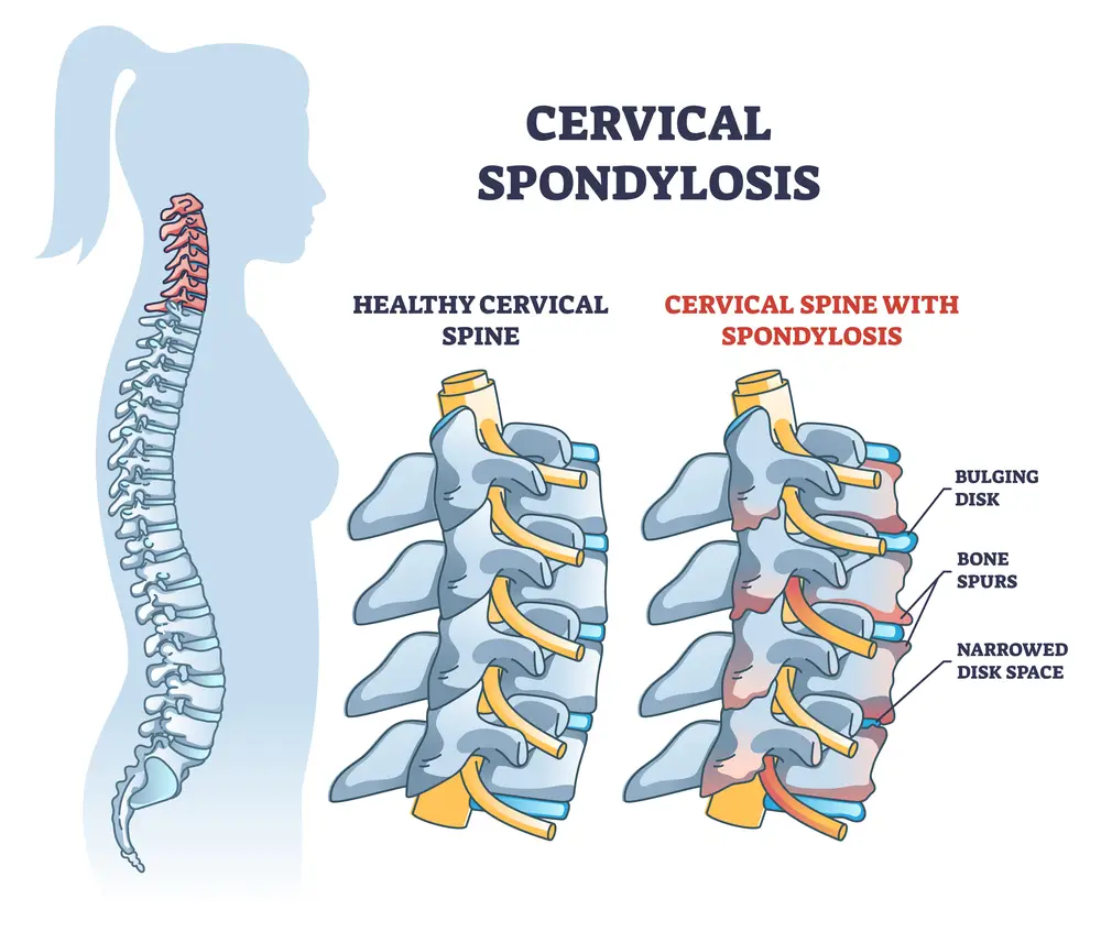 Cervical Spondylosis