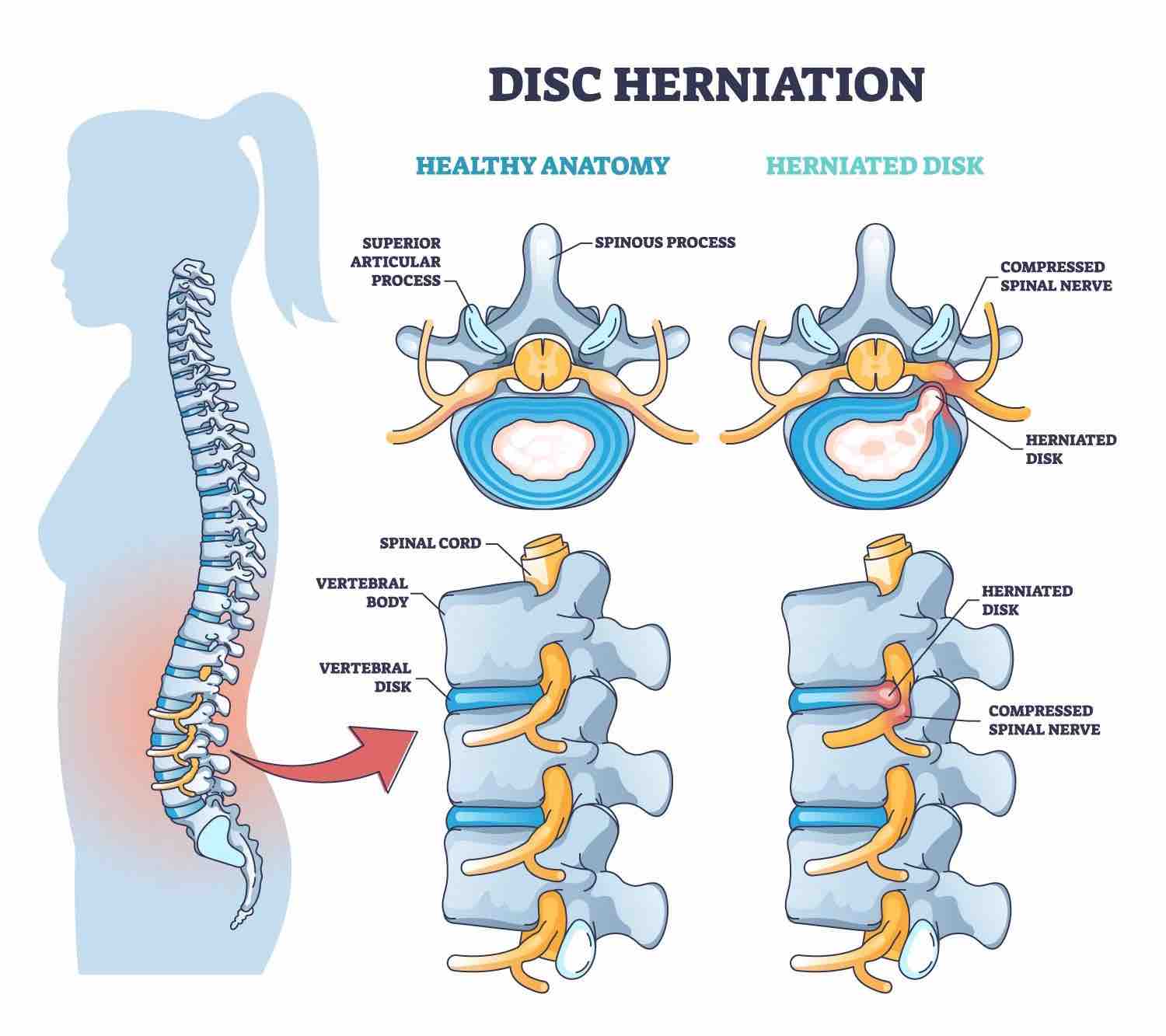 Herniated Disk  Treatment in Richmond Hill