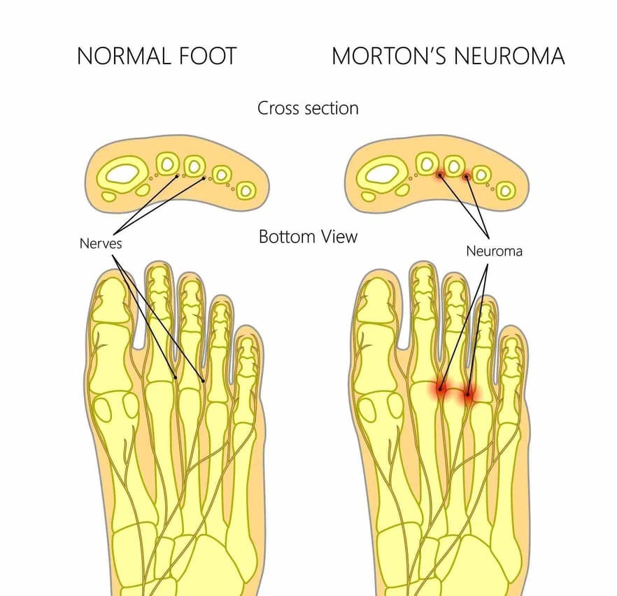 Morton’s Neuroma treatment in Richmond Hill