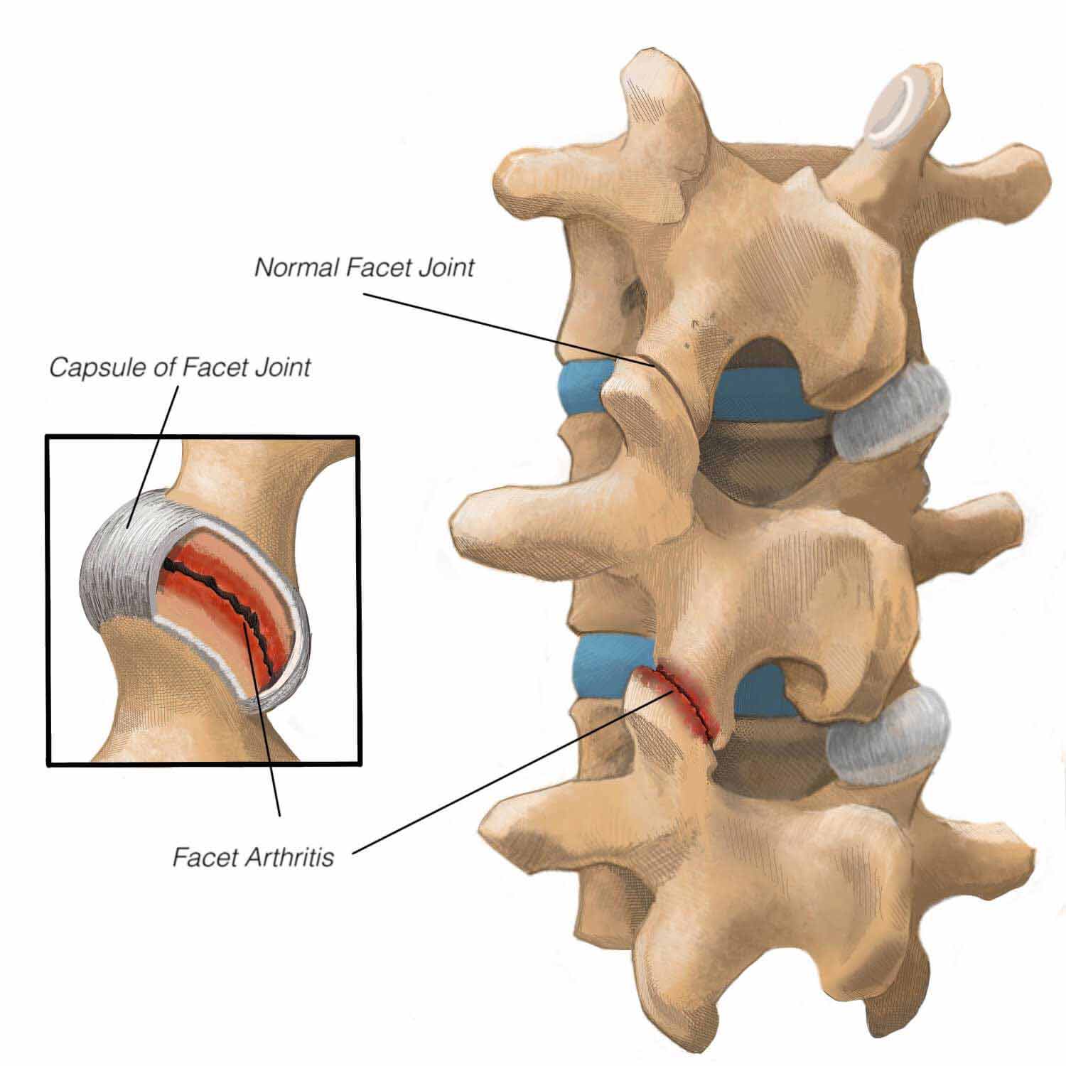 Facet Arthritis