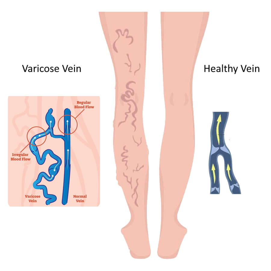 Varicose veins