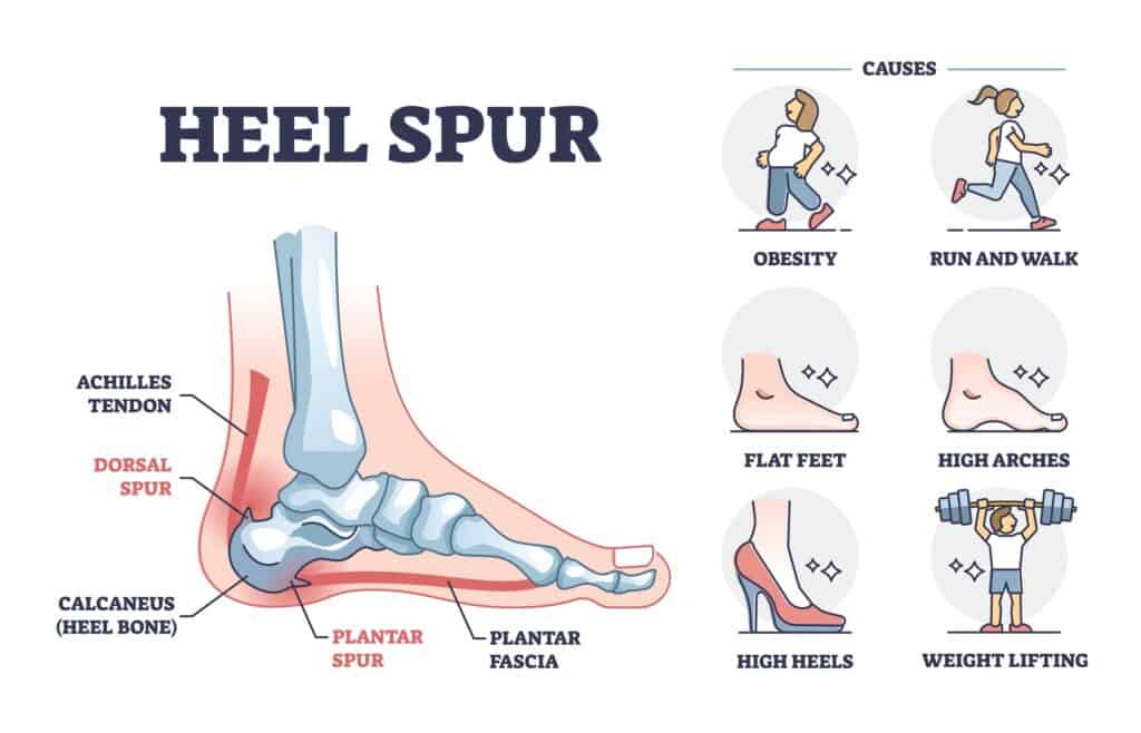 Heel Spur Risk Factors Diagram