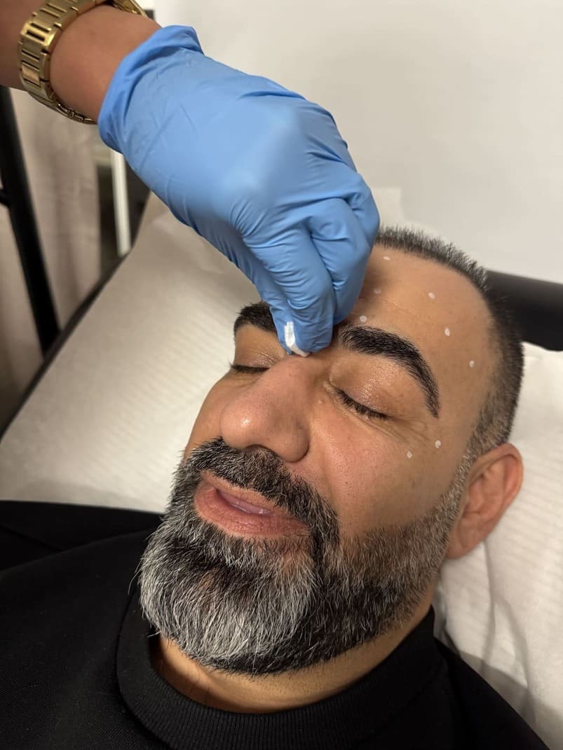 Botox injection in Richmond Hill