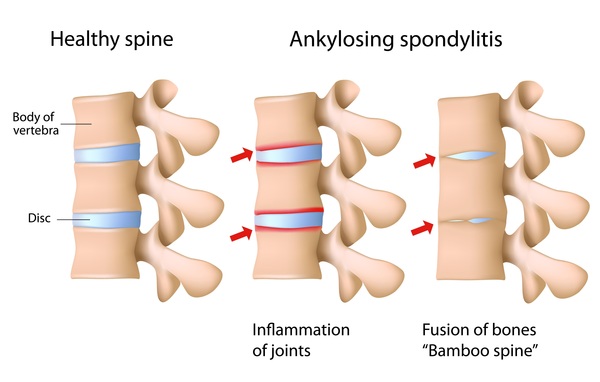 Spondylitis (Vertebral Inflammation)