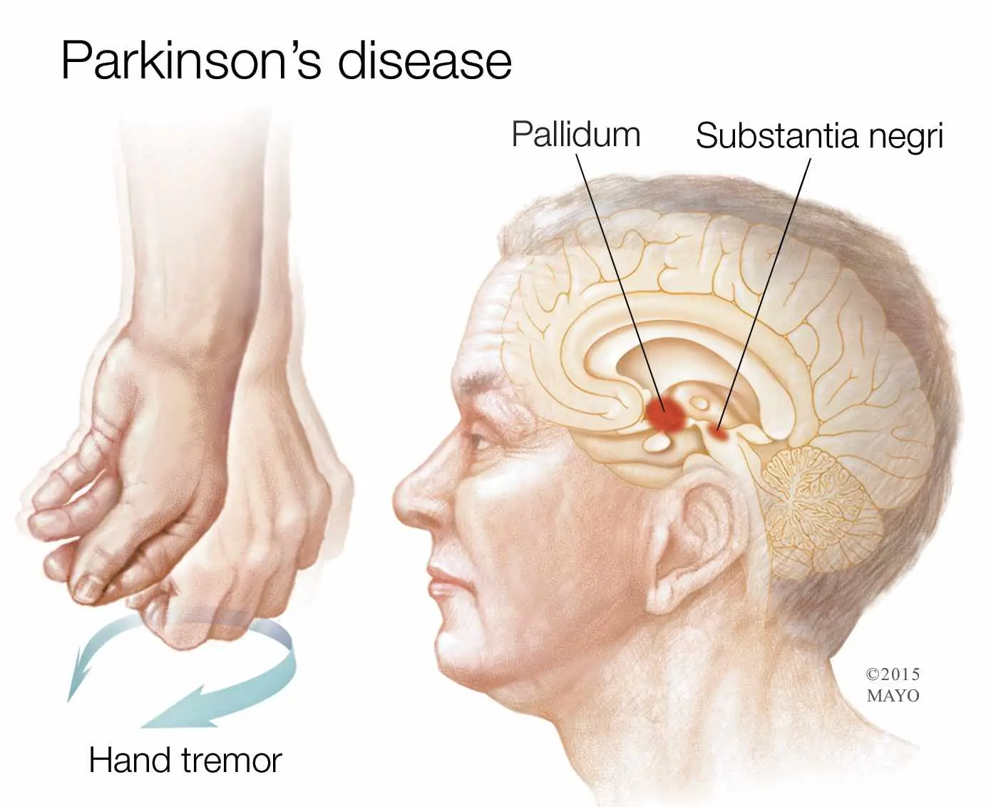 Parkinsons