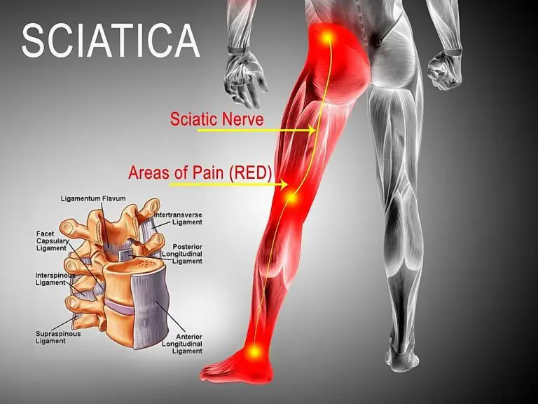 sciatica