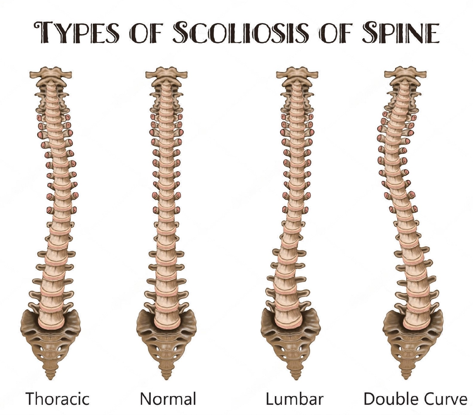 Scoliosis 3