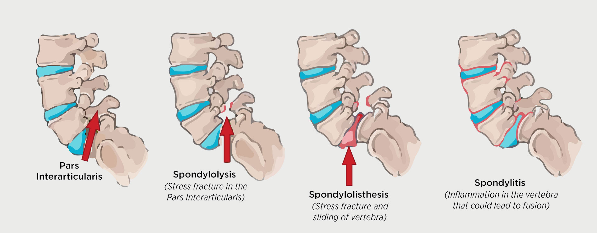 Spondylosis – Spondylolysis – Spondylolisthesis