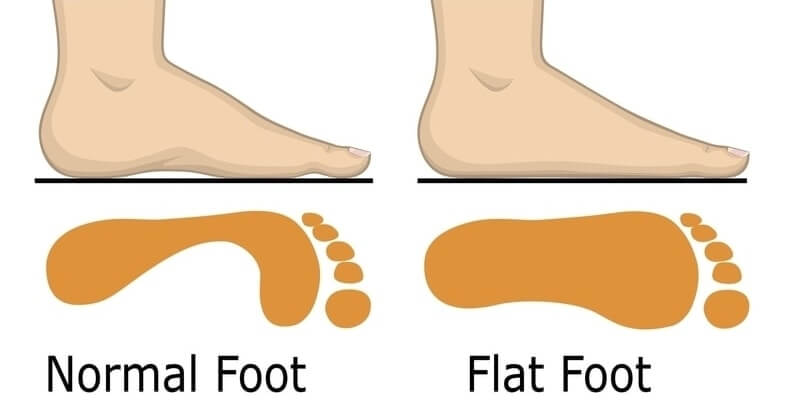 What Are Flat Feet