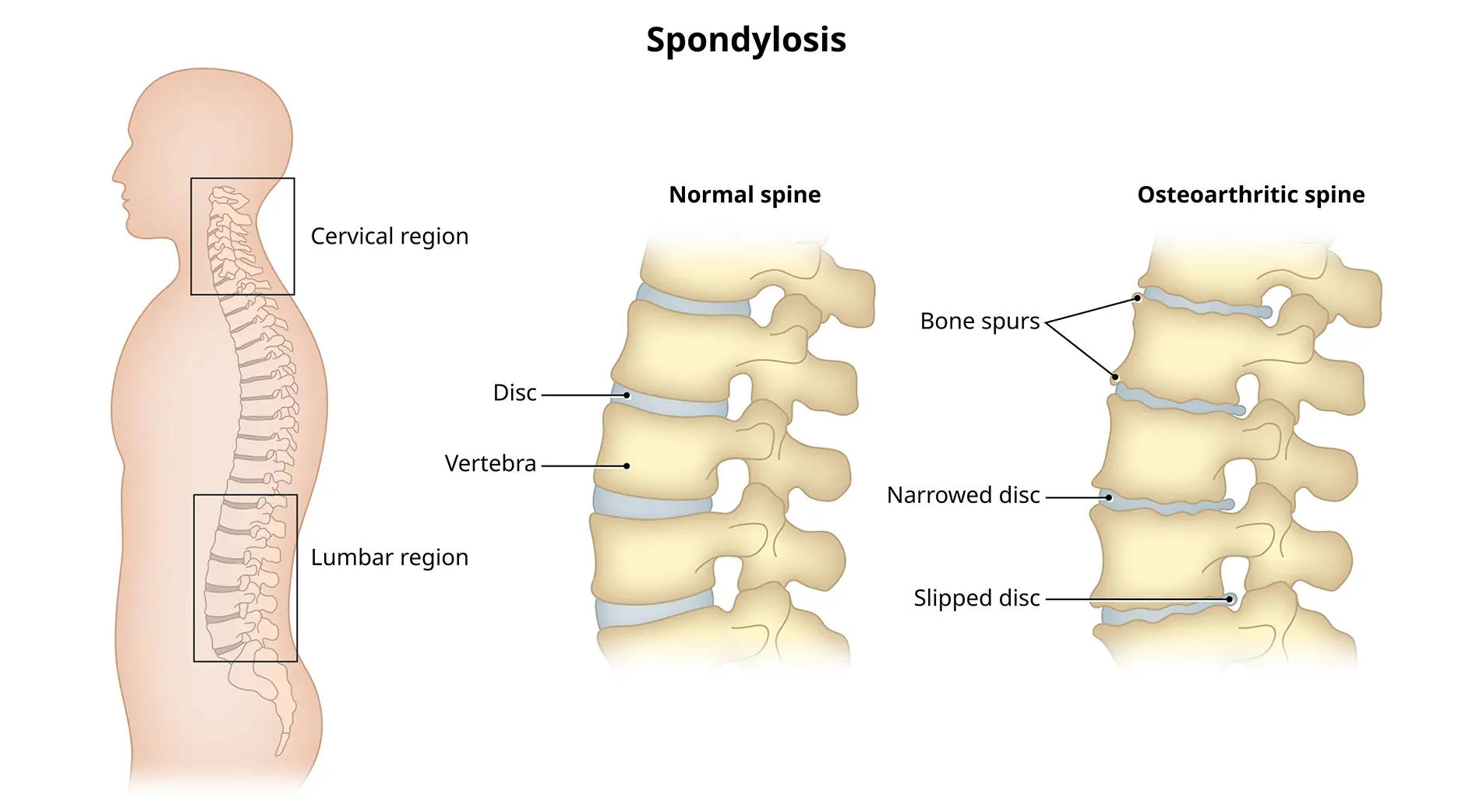 Cervical Spondylosis