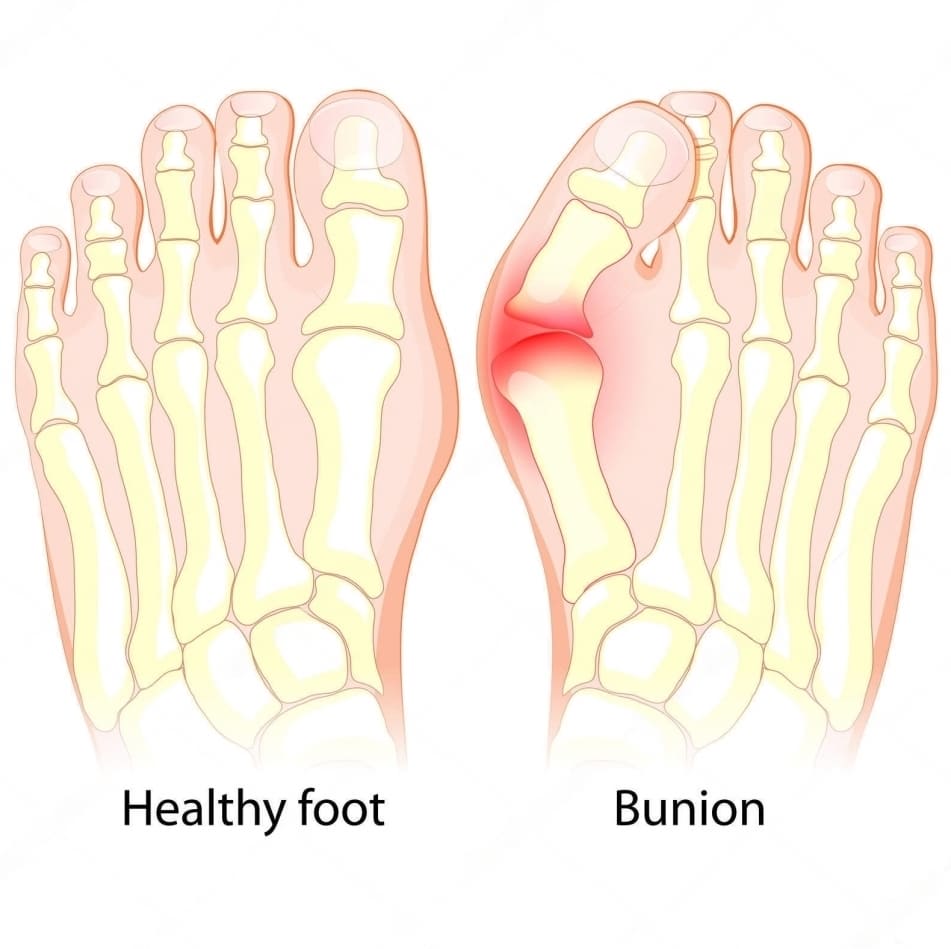 hallux valgus