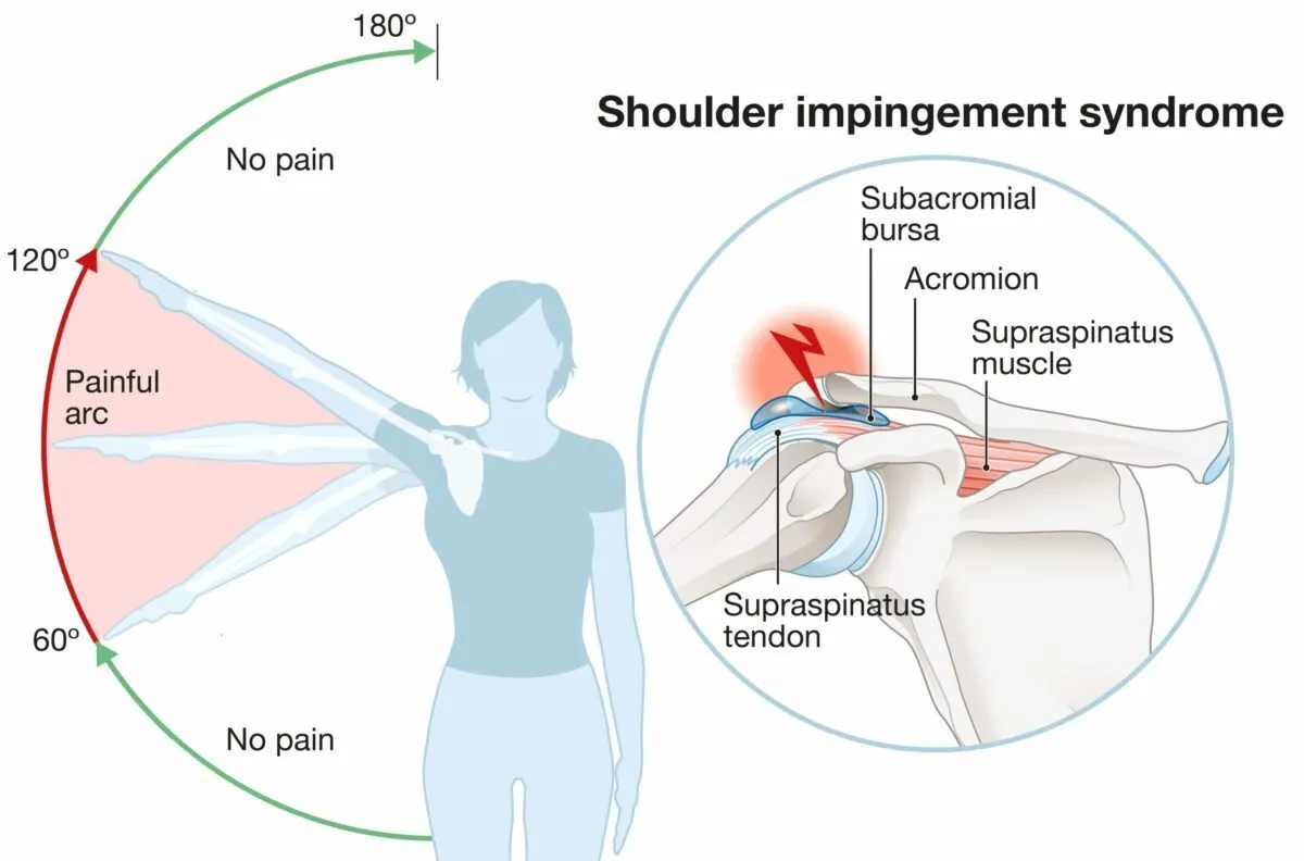 Shoulder Impingement