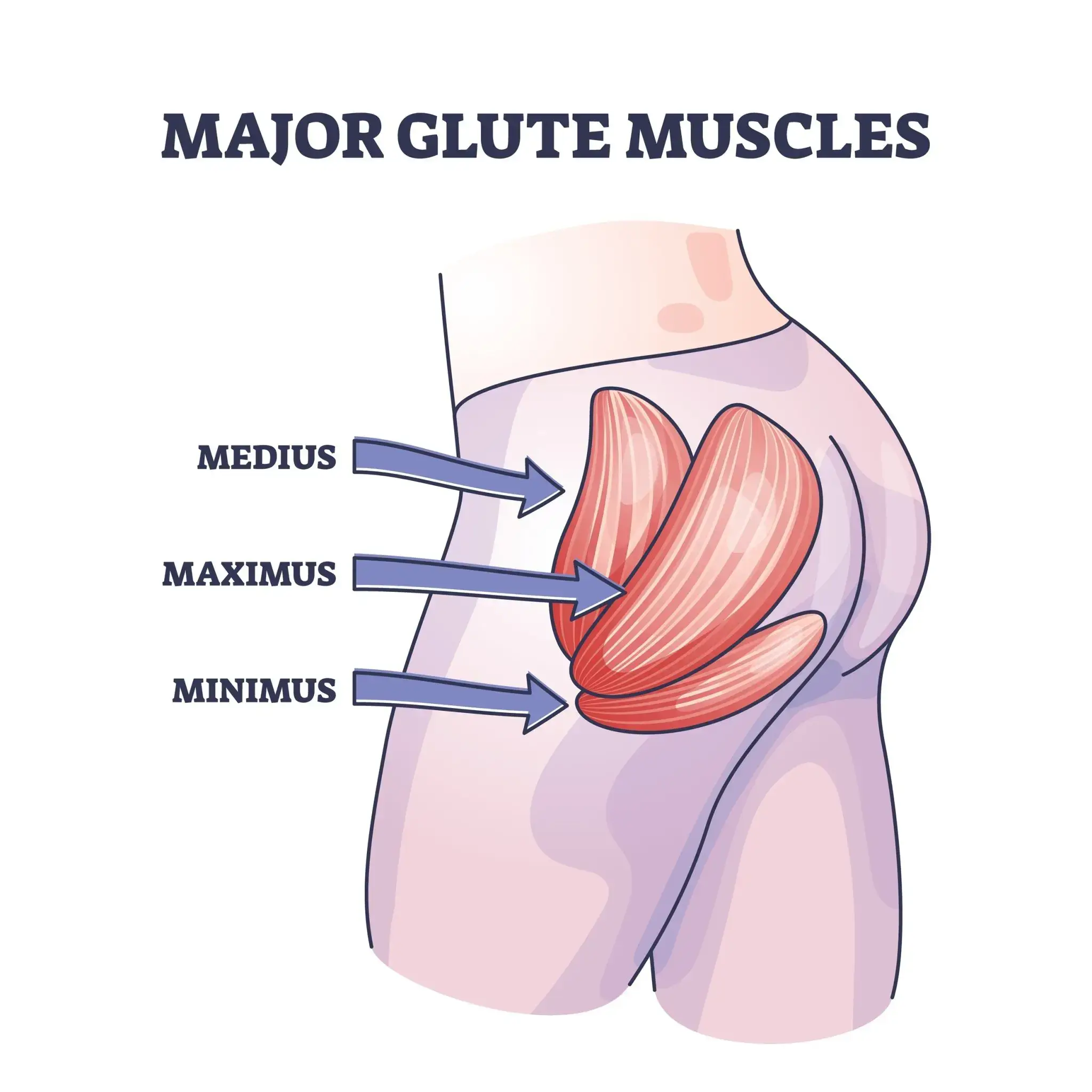 Gluteal Tendinopathy