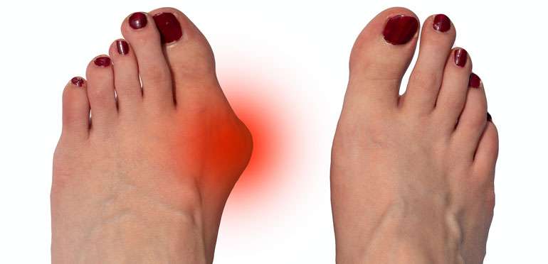 Foot Pain Causes Bunion Foot