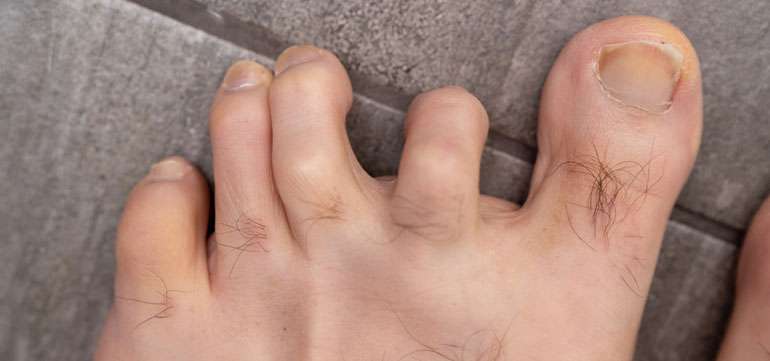 Foot Pain Causes Hammer Toes