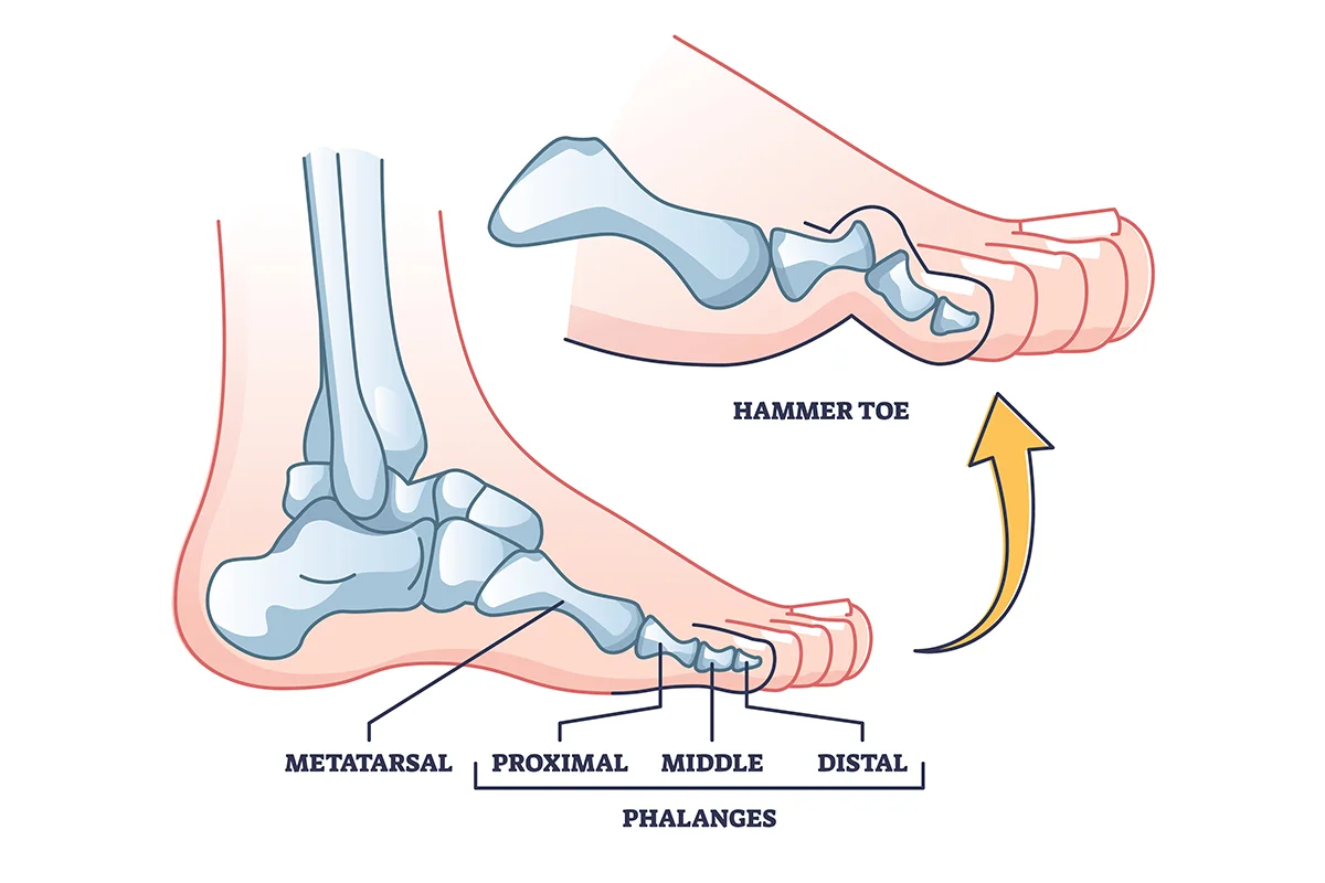 Foot Pain Causes Hammer Toes