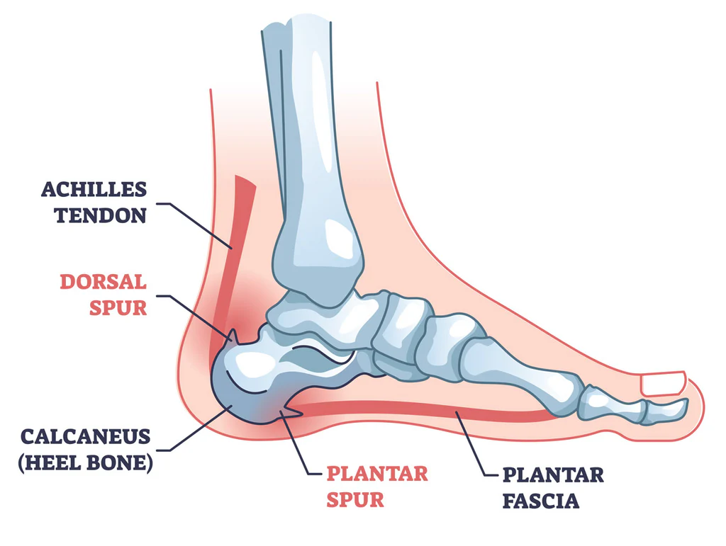  heel spur Treatment in Richmond Hill